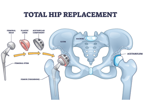 Hip implant with integrated force sensors
